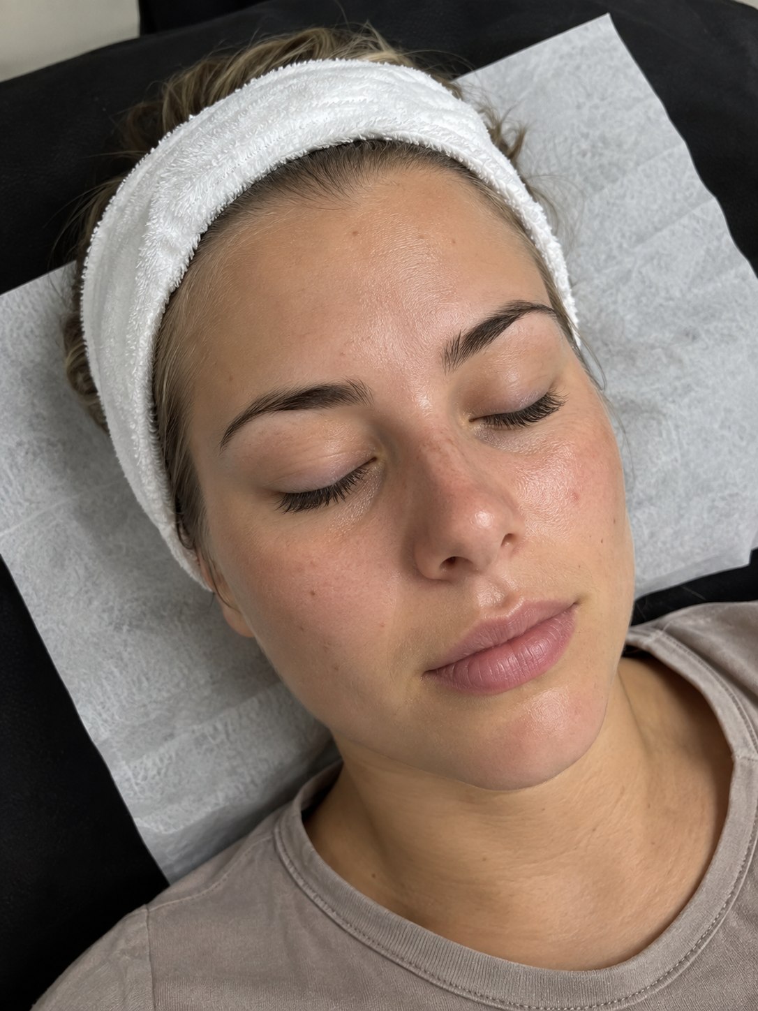 Imagen ilustrativa de hidralift facial